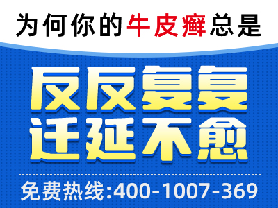 牛皮癣早期症状探索：初次斑块、肤色改变和皮肤异常的初期迹象